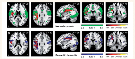 Anatomical correspondence between fronto-parietal SLF and activation for a contrast which highlights sublexical processing in control subjects (A) and semantic dementia patients (B). fMRI activations for the contrast of low-frequency regular words and pseudowords versus rest are shown in green (A) for healthy controls and in blue (B) for semantic dementia patients. The healthy control group and the semantic dementia patients both showed activation of posterior inferior frontal gyrus and inferior parietal cortex. Probabilistic maps of the left fronto-parietal SLF obtained in healthy controls (A) and semantic dementia patients (B) are shown in a colour scale which indicates the degree of overlap among subjects. Results are superimposed on the MNI standard brain in neurological convention (right is right).