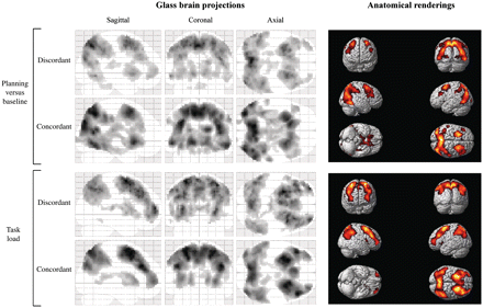 Brain regions showing increased functional MRI signal during Tower of London cognitive planning. Glass brain overviews depict brain activity patterns for ‘planning versus baseline’ (top) and ‘task load’ (bottom) contrasts in discordant and concordant twins. Anatomical renderings on the right illustrate locations of functional brain activation for the ‘planning versus baseline’ (top) and ‘task load’ (bottom) contrasts, across all concordant twins.
