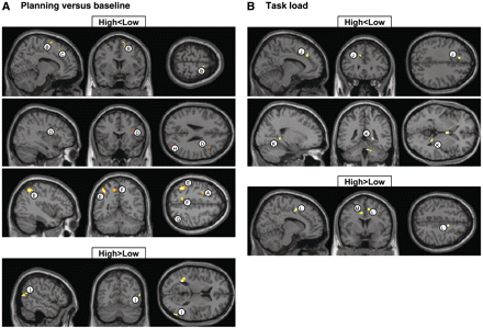 Brain regions showing reduced (top: high < low) and increased (bottom: high > low) functional MRI signal in twins with high obsessive–compulsive symptoms scores versus twins with low scores from the discordant group. (A) ‘Planning versus baseline’ contrast; (B) ‘task load’ contrast.