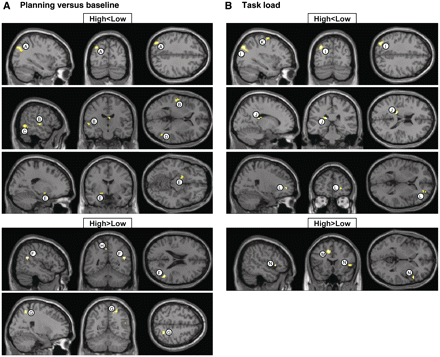 Brain regions showing reduced (top: high < low) and increased (bottom: high > low) functional MRI signal in concordant-high versus concordant-low twins. (A) ‘Planning versus baseline’ contrast; (B) ‘task load’ contrast.
