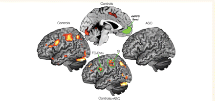 Functional connectivity in ventromedial prefrontal cortex during self-judgements compared with other-judgements (Self > Other). This figure displays increases in ventromedial prefrontal cortex (seed region labelled in green) connectivity for self-judgements compared with connectivity during other-judgements (Self > Other). Connectivity within the control group is displayed on the left and top middle brains, while connectivity within the ASC group is displayed on the right (both displayed at P < 0.05 FDR corrected). Group differences (Controls > ASC) in connectivity (bottom middle) are displayed at P < 0.005, uncorrected for display purposes.