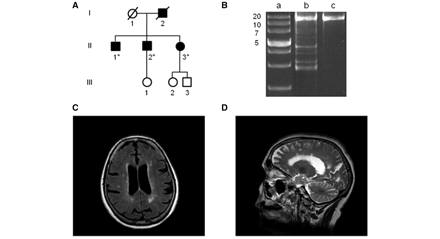 Molecular investigations and MRI neuroimaging of a 58-year-old female presenting with a multiple sclerosis-like illness and harbouring a c.2613 + 1g>a splice-site mutation within intron 25 of the OPA1 gene (UK-6). (A) Family tree of the affected proband (II-3). DNA samples were obtained from her 62-year-old (II-1) and 59-year-old (II-2) brothers, who both had a pure DOA phenotype, and OPA1 sequencing confirmed the presence of the same heterozygous c.2613 + 1g>a variant. The asterisk indicates family members where DNA samples were available for molecular analysis. (B) A 16 kb long-range PCR assay was performed on homogenate DNA extracted from the patient’s skeletal muscle biopsy, and multiple deletion bands were identified. Lane a: 1 kb DNA ladder with the adjacent numbers indicating the size of the band; lane b: patient; lane c: wild-type control. (C) Axial T2-weighted fluid attenuated inversion recovery and (D) sagittal T2-weighted turbo spin echo slices showing cortical atrophy and characteristic white matter lesions in the periventricular areas and more peripherally near to grey matter.