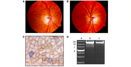 Clinical, histochemical and molecular features observed in a 59-year-old female with isolated optic nerve involvement due to an exon 27 c.2713C>T (p.R905X) OPA1 missense mutation. (A) Right, and (B) left optic discs displaying generalized pallor of the neuro-retinal rim and pathological excavation. (C) Dual COX-SDH histochemistry performed on 20 µm thick cryostat sections showing the presence of COX-deficient muscle fibres (33/1100, 3.00%). (D) Long-range PCR of the patient’s homogenate skeletal muscle DNA revealing multiple deletion bands in addition to the wild-type 16-kb fragment. Lane a: 1-kb DNA ladder with the adjacent numbers indicating the size of the band; lane b: patient; lane c: wild-type control.
