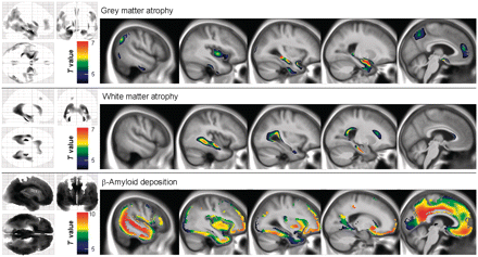 Brain areas of significant grey matter atrophy, white matter atrophy and increased PiB uptake in patients with Alzheimer’s disease (n = 34) compared with healthy elderly subjects (n = 93). All results are displayed at P < 0.05 (family-wise error-corrected), k > 1000.