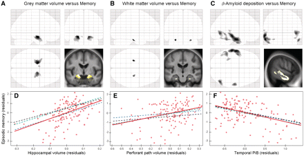 Results of the voxel-based regression analyses showing (A) the significant relationships between episodic memory and grey matter volume at P < 0.05 (family-wise error-corrected), (B) white matter volume at P < 0.001 (uncorrected) and (C) PiB at P < 0.005 (family-wise error-corrected) within the whole non-demented population (n = 136), displayed as statistical parametric mapping ‘glass brain’ and superimposed onto a representative anatomical section from the group mean magnetic resonance image. Differential statistical thresholds were applied to select areas of strongest correlation for each modality. Bottom: Partial regression plots of the relationship between memory and each modality entered in separate models with residuals being plotted for each variable to adjust for age, gender and years of education. Hippocampal volume (D) was significantly associated with memory when entered in the model separately (red solid slope) or together with perforant path volume (blue dashed slope), or temporal PiB (green dashed slope) or both (black dashed slope). Perforant path volume (E) was significantly associated with memory when entered in the model separately (red) or together with temporal PiB (green), but not when entered together with hippocampal volume (blue), or both hippocampal volume and temporal PiB (black). Temporal PiB (F) was significantly associated with memory when entered in the model separately (red) or together with hippocampal volume (blue), or perforant path volume (green) or both (black). Corresponding R2,T and P values are reported in Table 2.