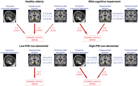 Illustration of the relationships between hippocampal atrophy, perforant path disruption and temporal PiB (blue), and between these three variables and episodic memory deficits (red) assessed within the separate subgroups. Values indicate ΔR2 (corresponding P-value), i.e. the added value of the variable to the model in percent (Supplementary Tables).