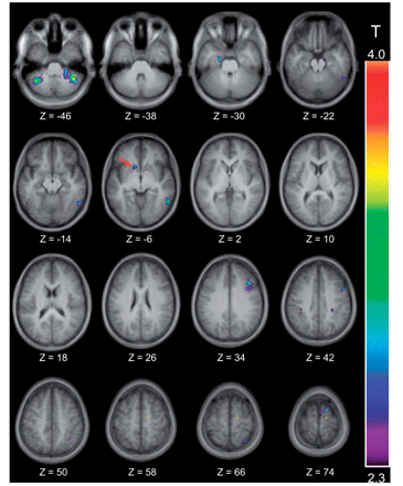 Location of the significant peaks observed in the congruent versus the switch control condition. The thresholded activation map is shown over the anatomical MRI, which is the average of the T1 acquisitions of the 13 participants transformed into stereotaxic space (ICBM152 template). Horizontal sections are shown ranging from Z = −46 to Z = 74 every 8 mm. Significant activation is observed in the left nucleus accumbens at Z = −6, which is indicated by a red arrow.