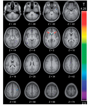 Location of the significant peaks observed in the incongruent versus the non-switch control condition. The thresholded activation map is shown over the anatomical MRI, which is the average of the T1 acquisitions of the 13 participants transformed into stereotaxic space (ICBM152 template). Horizontal sections are shown ranging from Z = −46 to Z = 74 every 8 mm. Significant activation is observed bilaterally in the caudate nucleus at Z = 2, which is indicated by two red arrows.