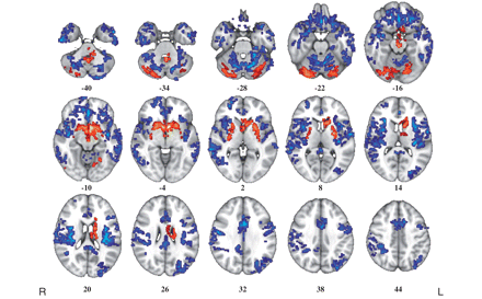 Whole-brain maps of significant differences in grey matter volume between healthy volunteers and cocaine users. Voxels coloured blue indicate brain areas in which cocaine users have reduced grey matter volume compared with healthy volunteers, and voxels coloured red indicate brain areas in which cocaine users have abnormally increased grey matter volume. These results were generated by permutation testing of voxel cluster statistics with cluster-wise P < 0.001, at which level we expect less than one false positive cluster per map. The statistical results are overlaid on the FSL MNI152 standard T1 image and the numbers beneath each section of the image refer to its position (mm) relative to the intercommissural plane in standard stereotactic space. L = left; R = right.