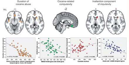 Maps of brain regions demonstrating significant association between grey matter volume and measures of duration of cocaine use, compulsivity and impulsivity in the group of cocaine users. Regions where grey matter volume correlated significantly with the duration of cocaine use in drug users are indicated in orange. Regions that correlated significantly with compulsive cocaine-taking (as assessed by the OCDUS) are coloured in green. Regions where grey matter volume correlated significantly with the inattention component of impulsivity in cocaine users are indicated in red (if the correlation was positive) and blue (if the correlation was negative). The scatter plots beneath each section of the brain image show the correlation between these measures and the total grey matter volume for each drug user in those regions found to be significantly correlated by permutation testing of cluster-level statistics in the restricted search volume or mask defined by the areas of significant between-group difference in grey matter anatomy (Fig. 1). The probability threshold for significance was P ∼ 0.002 for each analysis, at which level we expect less than one false positive cluster per map. The statistical results are overlaid on the FSL MNI152 standard T1 image and the numbers above each section of the image refer to its plane position (mm) relative to the origin in MNI stereotactic space. L = left; R = right.