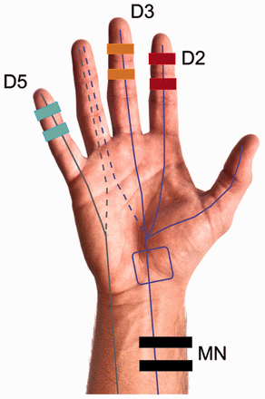 Hand stimulation sites. The median nerve (MN) innervates the first three digits (purple lines) and part of the fourth, whereas the ulnar nerve innervates the fifth digit and part of the fourth (grey lines). In carpal tunnel syndrome, the median nerve becomes entrapped within the carpal tunnel (purple box). The ulnar nerve is not affected in carpal tunnel syndrome. Subjects were stimulated at four locations: the index Digit 2 (D2, red), middle Digit 3 (D3, orange), pinky Digit 5 (D5, blue) fingers and the median nerve (black) at a location proximal to the entrapment site.
