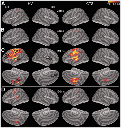 Grand average responses to digit stimulation. Stimulation of median and ulnar nerve-innervated digits evoked bilateral brain response with a characteristic temporal pattern. Responses are shown here on the average inflated surface (dark grey are sulci and light grey are gyri). (A) In healthy controls (HV), response first peaked in contralateral S1 cortex ∼26 ms. (B) Initial S1 response appeared slightly later in subjects with carpal tunnel syndrome at ∼31 ms post-stimulus. (C) By 113 ms post-stimulus, contralateral S2, ipsilateral S2 (iS2) and medial cortex including supplementary motor areas (SMAs) were active in both subject groups. In carpal tunnel syndrome, some response also localized within anterior cingulate areas (circle). (D) By 150 ms post-stimulus, all evoked responses had dissipated in both subject groups. PFC = prefrontal cortex.