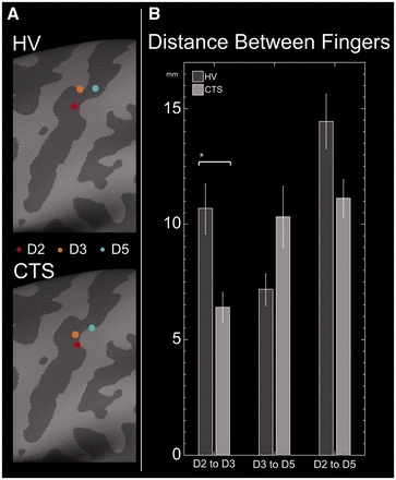 S1 digit somatotopy. (A) In both healthy controls (HV) and subjects with carpal tunnel syndrome (CTS), digit sources lay within the contralateral central sulcus. Here, average digit positions Digit 2 (red dot), Digit 3 (orange) and Digit 5 (blue) for each group are shown on the average inflated cortical surface. Specifically, dark grey represents sulci, whereas light grey represents gyri. In both subject groups, digit locations roughly followed the expected somatotopic distribution with index, middle and pinky digits mapping in a lateral to medial order. (B) All digit separation distances were shorter in carpal tunnel syndrome, but only the Digit 2–Digit 3 distances were significantly different in non-parametric tests (*P < 0.05, Mann–Whitney U-test).