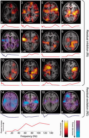 Clusters including power changes in auditory cortex. Each cluster’s spatial representation is displayed by showing a single representative axial slice at the level of the superior temporal plane. Each cluster is accompanied by the patient’s number (upper left) and tinnitus laterality (lower left), and its frequency spectrum is shown below the axial brain image. Red and yellow colours indicate power increases as a function of increased tinnitus intensity, and blue colours indicate power decreases as a function of increased tinnitus intensity. The upper 12 clusters represent residual inhibition, and the lower four clusters residual excitation. Bottom left: Plot showing one cluster’s frequency spectrum in greater detail to illustrate the frequency axis and highlight that the vertical axis indicates power change at each frequency (positive/red for power increases, negative/blue for decreases). The colour scales (bottom right) correspond to the power increases and decreases shown on the axial brain slices.