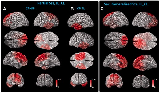 IL–CL source analysis. (A) Cortical slow-wave distribution of the first to eighth clusters as shown Fig. 3, which had higher in complex partial (CP) than in simple partial (SP) seizures, and (B) the ipsilateral and contralateral temporal (CP TL) slow-wave distribution. The source maps of clusters are weighted by their relative of complex partial seizures, summed and displayed on the cortex model. In secondarily generalized seizures (Sec. Generalized Szs), the slow-wave distribution (C) showed similar spatial coverage. Note that for this analysis the left side denotes the ipsilateral side to seizure onset while the right denotes the contralateral side. The color bar is scaled to the maximal value of each category as shown in Fig. 3.