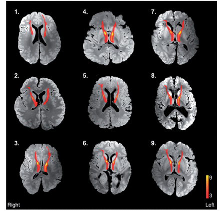 Results of control mediodorsal nucleus of the thalamus-prefrontal cortex tract output registration into structural space of individual post-mortem MRI scans of multiple sclerosis brains. Structural images were obtained using a balanced steady-state-free precession sequence. Tracts have been thresholded to display only those present in ≥ 3/9 control subjects. Case numbering corresponds to Table 1.