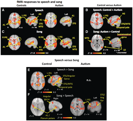 Functional MRI responses during speech and song stimulation. (A) Speech: control subjects (left) activated A1, temporal regions [superior temporal gyrus (STG); middle temporal gyrus (MTG) and angular gyrus (AG)] and left inferior frontal gyrus (IFG, circles), as well as SMA. Autistic subjects (right) activated A1 and superior temporal gyrus, but not in left inferior frontal gyrus (empty circles), supplementary motor area (SMA) or midline regions. (B) Speech: control < autism contrast confirmed greater activation in regions outside A1 in control subjects. (C) Song: both controls (left) and autistic (right) children activated A1 and right inferior frontal gyrus. Autistic subjects also activated left inferior frontal gyrus (circles). (D) Song: autism > control contrast showed greater activation in left inferior frontal gyrus (uncorrected). (E) Control: speech > song showed greater activity in left inferior frontal gyrus, left temporal regions, and midline structures (F) Control: song < speech contrast showed increased activation in right temporal and parietal regions. Autism: song > speech showed greater activation in bilateral inferior frontal gyrus and temporal regions. L = left; LO = lateral occipital cortex; n.s = not significant; R = right.