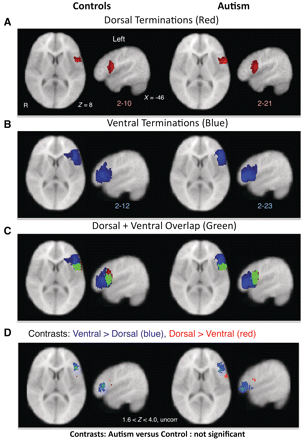 DTI tractography of dorsal and ventral language pathways. (A–C) Termination points (with a minimum overlap of two subjects for visualization purposes) of left dorsal (A, red) and ventral (B, blue) pathways in control (left) and autistic (right) subjects as determined by DTI tractography from A1 to inferior frontal gyrus. (C) Green represents areas that overlapped for both dorsal and ventral terminations. (D) Within-group comparisons between proportions of subjects with dorsal and ventral terminations in inferior frontal gyrus. In both control and autistic subjects, ventral > dorsal terminations (blue) were more anterior and dorsal > ventral terminations (red) were more posterior (Z > 1.6, P < 0.05, uncorrected). Analysis failed to confirm differences in terminations of either tract for control versus autistic comparisons. R = right.