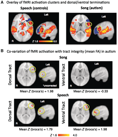 Relationship between function and structure. (A) Functional MRI (fMRI) activation for the speech condition in controls (left) and the song condition in autistic children (right) overlaid on dorsal (red) and ventral (blue) termination points show that activation in left inferior frontal gyrus overlap almost entirely with dorsal terminations (yellow circle). (B) Correlations between functional MRI activation during song and speech within left inferior frontal gyrus region of interest and fractional anisotropy (FA) values of left dorsal and ventral tracts. (B, top) Song: activity in left inferior frontal gyrus positively co-varied with left dorsal fractional anisotropy values (Z > 1.6, P < 0.05, uncorrected). (B, bottom) Speech: activity in left inferior frontal gyrus was correlated with fractional anisotropy of left dorsal and ventral tracts (Z > 1.6, P < 0.05, cluster corrected at P < 0.05).