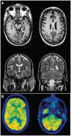 Neuroimaging on illustrative Family member 3. MRI at the age of 54 (A). Top: T1 axial images at the level of hippocampus (left) and corona radiata (right), demonstrating anterior frontal and temporal lobar atrophy (left > right). Bottom: T2 coronal images at the level of the hippocampus (left) and cerebellum (right), further demonstrating the asymmetric atrophy and showing hippocampal atrophy that is mild compared to the degree of cortical involvement. FDG-PET at the age of 54 years (B) shows hypometabolism in the frontal lobes relative to the occipital cortex at the level of the basal ganglia (left) and the cerebellum (right).