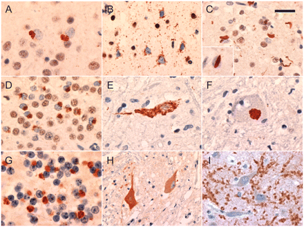Neuropathological features associated with the C9ORF72 mutation. All cases showed compact and granular TDP-43-immunoreactive neuronal cytoplasmic inclusions in the neocortex, typical of FTLD-TDP type B (A). Granular neuronal pre-inclusions in neocortex layer II were common (B). A subset of cases had compact neuronal cytoplasmic inclusions, short neurites and rare lentiform neuronal intranuclear inclusions (inset) in layer II neocortex, consistent with FTLD-TDP type A (C). Compact and granular neuronal cytoplasmic inclusions in hippocampal dentate granule cells were a consistent feature (D). Lower motor neurons contained neuronal cytoplasmic inclusions with granular, filamentous (E) or compact Lewy body-like morphology (F). Small neuronal cytoplasmic inclusions and short neurites in the granule cell layer of the cerebellar cortex were immunoreactive for ubiquitin and p62, but negative for TDP-43 (G). Increased cytoplasmic staining of some lower motor neurons was seen in cases of ALS, both with and without the C9ORF72 mutation (H). In all cases of FTLD (with and without the C9ORF72 mutation) hippocampal pyramidal neurons were surrounded by coarse punctate staining, consistent with enlarged presynaptic terminals (I). Immunohistochemistry for TDP-43 (A–F), ubiquitin (G) and C9ORF72 (H and I). Scale bars: A, D–F, H and I = 25 µm; B and C = 30 µm; G = 12 µm.