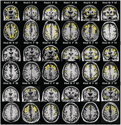 Atrophy patterns in individual subjects. MRI scans of individual subjects overlaid with regions of severe atrophy in yellow using MRI STAND-maps (Z-score less than −2.5 relative to normals was used as a threshold). The brightness of the overlaid colour indicates the degree of atrophy. Numbers represent age of each subject in years. Kind = kindred; P = proband; R = relative.