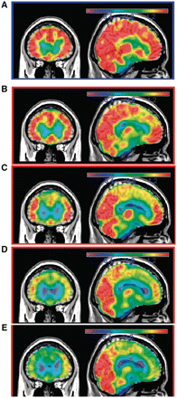 Individual subject relative SPECT intensity maps. SPECT maps shown for a 54-year-old healthy control subject (A), 51-year-old with behavioural variant FTD (B), 51-year-old with behavioural variant FTD (C), 56-year-old with FTDP/ALS (D), and 63-year-old with behavioural variant FTD (E). The relative SPECT intensity for each subject's normalized SPECT scans is overlaid on a template brain for anatomical reference. The healthy control subject is displayed at the top (blue box), and images for subjects B to E are arranged in increasing order of severity of anterior cingulate reduction in SPECT intensity. Colour bar encodes SPECT intensity relative to pontine region of interest.