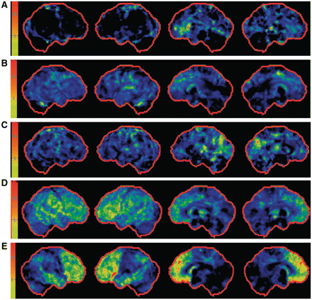 Fluorodeoxyglucose-PET Z-score 3D-SSP images. PET images shown for a 68-year-old with behavioural variant FTD (A), 69-year-old with behavioural variant FTD (B), 64-year-old with behavioural variant FTD (C), 53-year-old with behavioural variant FTD (D), and 57-year-old with behavioural variant FTD (E). The images from left to right are right lateral, left lateral, right medial, and left medial Z-score projection maps. The upper two rows show mild frontal cortical and cingulate hypometabolism while the lower two show moderate to severe dorsolateral frontal, anterior temporal cortical and cingulate hypometabolism. The middle subject images show a parietal/precuneus pattern of hypometabolism. Subject D in this figure is the same person as Subject B in Fig. 3.