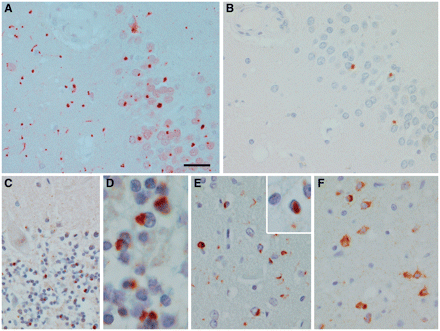 Microscopic findings of c9FTD/ALS. Ubiquitin immunohistochemistry (A) compared with phospho-TDP-43 immunohistochemistry (B) in adjacent sections of dentate fascia of hippocampus (Kindred 14, Case 1.III.1). Note considerably more neuronal inclusions and neurites with ubiquitin. Ubiquitin-positive cerebellar inclusions in same case at lower magnification (C) and higher magnification (D). Frontal cortex phospho-TDP-43 immunohistochemistry: type A in Patient III.1 from Kindred 5 shows short neurites, neuronal inclusions and intranuclear inclusions (inset); and type B in Patient IV.1 from Kindred 12 shows mostly neuronal inclusions, including so-called ‘pre-inclusions’. Scale bar = 30 μm for A–C, E and F and 6 μm for D and Einset.