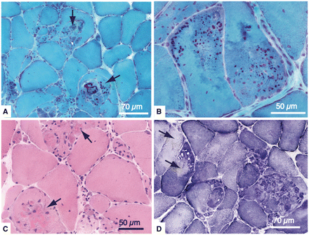 Muscle biopsy sections of the vastus lateralis muscle from Patient B II:1. (A and B) Groups of fibres show marked structural alterations with splitting and numerous red or purple inclusions/deposits in trichrome stained sections (arrows). (C) The deposits are partly eosinophilic and there are numerous internalized nuclei (haematoxylin–eosin). (D) NADH-terazolium reductase stained sections show pronounced structural alterations, including rubbed out areas in some fibres (arrow).