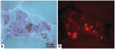 Serial sections of muscle biopsy from Patient B II:1 demonstrating that the purple or red deposits in trichrome staining contain actin. (A) Trichrome and (B) phalloidin–rhodamine fluorescence.