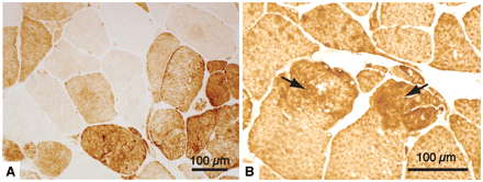 Immunohistochemical analysis. (A) Neural cell adhesion molecule is expressed in the majority of muscle fibres (Patient A III:16). (B) Titin appears to be accumulated in some regions of abnormal fibres (arrows) (Patient A IV:4).