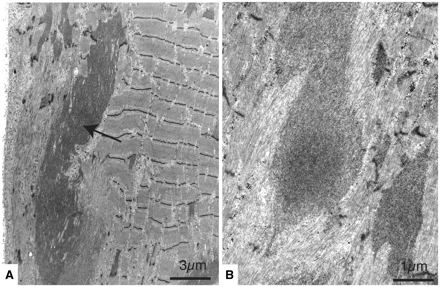 Electron micrographs. (A) In the periphery of the fibre, there is an elongated deposit of dense and partly fibrillar material (arrow) with connection with altered Z-disks. There is also Z-disk streaming (Patient A III:14). (B) Irregular electron-dense inclusions with partly fibrillar structure (Patient A III:14).