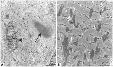 Electron micrographs. (A) A degenerated nucleus (arrowhead) and globular deposit of dense material surrounded by fibrillar material (arrow). Thickened Z-disks and occasional rod-like structures can also be seen (Patient B II:1). (B) Extensive dispersion of semi-dense Z-disk derived material into and covering the entire sarcomere (Patient A III:16).