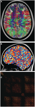 Overview of methodology. Whole-brain tractography was performed in each of 59 cannabis users and 33 non-users. (A) Tractography results were registered to standard space, shown here for a representative non-user. (B) Voxels of dimension 5 mm isotropic covered the entire cortex, twice greater than native resolution. The total number of streamlines interconnecting each voxel pair was enumerated, yielding a 14 398 × 14 398 connectivity matrix (C, only portion shown). Voxel pairs for which the streamline count differed significantly between cannabis users and non-users were identified with the network-based statistic.