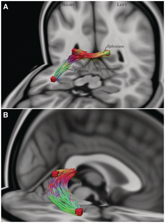 The right fimbria of the hippocampus, hippocampal commissure and splenium comprised fewer streamlines in cannabis users compared to non-users (P < 0.05, corrected). Voxels interconnected by fewer streamlines are coloured red and the corresponding streamlines via which they are interconnected are coloured such that: left–right is red, superior–inferior is blue and anterior–posterior is green. A and B show different oblique views. The splenium and hippocampal commissure are obscured in B by the sagittal slice of the underlay image.