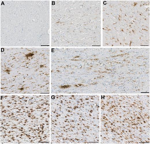 Representative images of observed CR3/43 immunoreactivity in the corpus callosum following TBI versus control subjects. (A–C) Representative images showing increasing CR3/43 reactivity with age as has been previously reported. (A) Virtually absent CR3/43 immunoreactivity in an 18-year-old female control subject who died as a result of leukaemia. (B) Minimal, highly ramified microglia observed in a 36-year-old female who died following a sudden cardiac event, and (C) numerous microglia with shortened, thickened processes and hypertrophy of the cell body, indicative of activation in a 92-year-old female who died as a result of bronchopneumonia. (D–E) Clusters of activated microglia with decreased ramifications in a (D) 23- and (E) 31-year-old male, who each died 4 weeks after TBI. Note the occasional cell displaying amoeboid morphology. In addition, cells can be seen arranging in parallel lines, likely along the length of an injured axon. (F–H) Extensive and densely packed amoeboid CR3/43 immunoreactive cells displaying minimal or no processes in (F) a 43-year-old male, 4 years post-TBI, (G) a 67-year-old male 8 months post-TBI and (H) a 64-year-old male 16 years post-TBI. All scale bars = 100 µm.