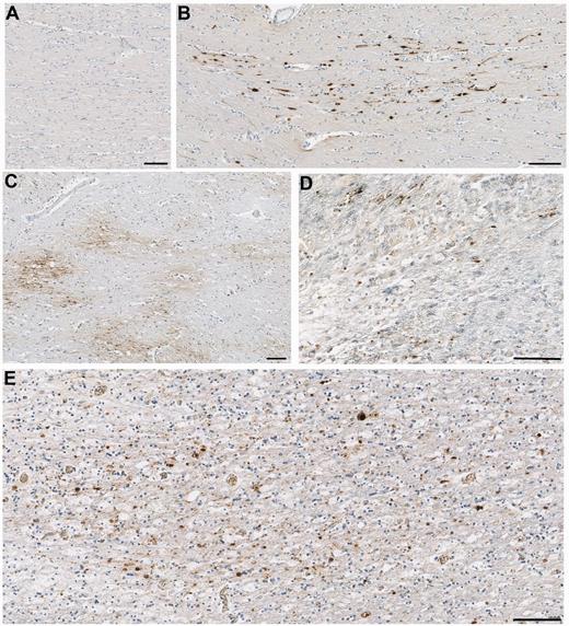 Representative images of axonal pathology in the corpus callosum as demonstrated by amyloid precursor protein immunoreactivity. (A) Normal white matter displaying no abnormal amyloid precursor protein immunoreactivity in a 67-year-old female who died following volvulus of the colon. (B) Axonal pathology with a distribution and morphology consistent with a traumatic origin in a 20-year-old male, 2 days post-injury. (C) Extensive axonal pathology in a pattern and distribution consistent with acute hypoxia-ischaemia in an 18-year-old male 10 h after TBI. (D) Small clusters of amyloid precursor protein immunonoreactivity consistent with the appearance of axonal bulbs in an 89-year-old female, 7 years post-TBI. On serial sections, the same region displayed extensive activated microglia as determined using CR3/43 and CD68 immunohistochemistry. (E) A similar pattern of multiple axonal bulbs in the corpus callosum of a 28-year-old male, 9 months post-TBI. Again, the same region displayed extensive activated microglia in serial sections. All scale bars = 100 µm.