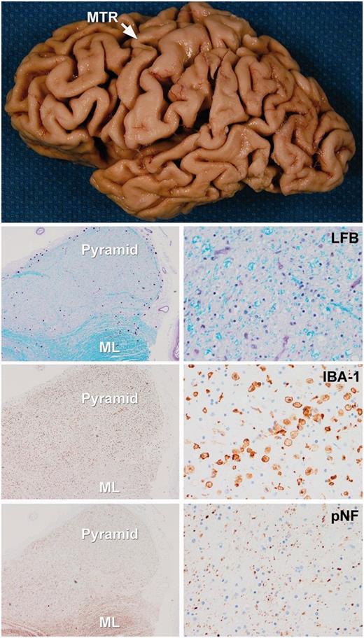 Figure demonstrating gross and histological features of a typical CSTD(+) case. There is gross atrophy of the motor cortex. Low power microscopic images (left images = ×100 magnification; right images = ×200 magnification) reveal loss of myelin on Luxol fast blue (LFB) stain, axonal loss on neurofilament (pNF) stain and the presence of activated microglia with IBA-1 in the medullary pyramids. In contrast, there is preservation of myelinated fibres in the adjacent medial lemniscus (ML). MTR = motor cortex.