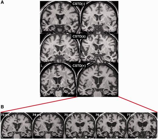 Coronal volumetric MRI for representative CSTD(−), CSTD(±) and CSTD(+) cases shown at the level of the anterior temporal lobes (A). The CSTD(+) cases both show right > left temporal atrophy, whereas the other cases show left > right temporal atrophy. One of the CSTD(+) cases had annual brain MRI scans for a period of 5 years, demonstrating progressive atrophy of both temporal lobes, although the right temporal lobe remained the more affected at each time point (B).