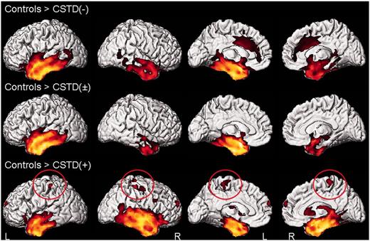 Patterns of grey matter loss in the CSTD(−), CSTD(±) and CSTD(+) groups compared with control subjects. Results are shown on 3D renderings uncorrected for multiple comparisons. Findings in the motor cortex are circled. L = left; R = right.