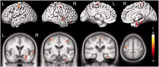 Regions that showed greater grey matter loss in the CSTD(+) subjects compared with the rest of the FTLD-TDP type C cases [CSTD(−) and CSTD(±)]. Results are shown on 3D renderings and on representative coronal and axial slices, uncorrected for multiple comparisons. L = left; R = right.