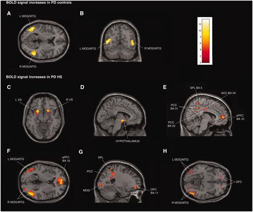 Transverse, coronal and sagittal sections of statistical parametric maps showing significant BOLD signal increases (yellow–red areas) associated with exposure to common sexual imagery in 12 Parkinson’s disease (PD) control patients (A and B) and in 12 patients with Parkinson’s disease with hypersexuality (PD HS) (C–H) during ON and OFF medication states. BOLD signal increases are illustrated in (A and B) left and right middle temporal gyrus (MTG) and middle occipital gyrus (MOG) (x = −48, y = −59, z = 9), (C) ventral striatum (VS) (x = 18, y = 15, z = − 11), (D) hypothalamus (x = −5, y = −4, z = −9), (E) anterior prefrontal cortex (aPFC), anterior cingulate cortex (ACC), superior parietal lobule (SPL) and posterior cingulate cortex (PCC) (x = 8, y = −16, z = 33), (F) left and right middle temporal gyrus and middle occipital gyrus and anterior prefrontal cortex (x = −8, y = 56, z = 4), and (G and H) orbitofrontal cortex (OFC), superior parietal lobule, posterior cingulate cortex, and left and right middle temporal gyrus and middle occipital gyrus (x = −24, y = 48, z = −8). The colour bar indicates z-values.