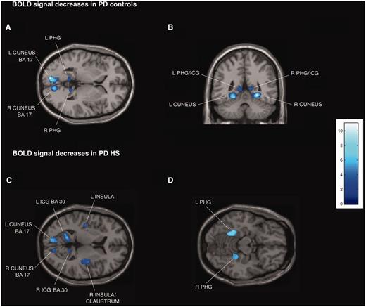 Transverse and coronal sections of statistical parametric maps showing significant BOLD signal decreases (dark and light blue areas) associated with exposure to common sexual imagery in 12 Parkinson’s disease (PD) control patients (A and B) and in 12 patients with Parkinson’s disease with hypersexuality (HS) (C and D) during the OFF medication state. BOLD signal decreases are illustrated in (A and B) left and right parahippocampal gyrus (PHG), isthmus of cingulate gyrus (ICG) and cuneus (x = −9, y = −47, z = 2), (C) left and right parahippocampal gyrus, cuneus, isthmus of cingulate gyrus, insula and right claustrum (x = −42, y = 14, z = 8), and (D) left and right parahippocampal gyrus (x = 22, y = 38, z = −14). In the ON medication state, in the group of 12 patients with Parkinson’s disease with hypersexuality, no BOLD signal decreases are detected. The colour bar indicates z-values.