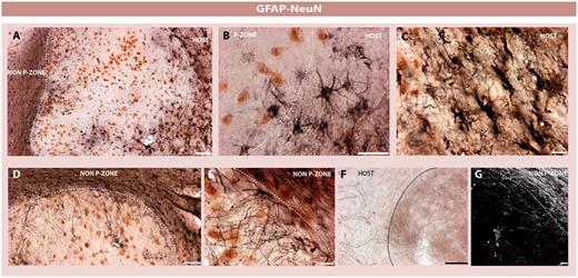 Astrocytic subtypes within the graft and surrounding brain. Double immunohistochemistry for neuronal elements (Neuronal nuclei (NeuN), revealed with the chromogen 3,3′ diaminobenzidene in brown) and astrocytes (GFAP, revealed with nickel-intensified 3,3′ diaminobenzidene in black) (A–E). Solid grafts were demarcated by an astrocytic response (A and B). Astrocytic cells, however, were rarely observed within the p-zones of the grafted tissue (A, B, D and E). When present, astrocytes projected radially within the p-zones and depicted the morphology of a resting cell (D, E and G) in comparison with the activated atrophic host astrocytes (B and C). The morphology of astrocytes differed according to tissue compartments of the graft and surrounding brain (A–E). Importantly, the circumferentially oriented astrocytes observed around the graft p-zones did not prevent the infiltration of tyrosine hydroxylase fibres arguing against the presence of a glial scar (F). Scale bars: A, B and C = 100 µm; D = 100 µm; E = 15 µm; F = 25 µm; G = 10 µm.