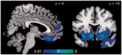 Regions with significantly reduced volumes in patients with behavioural variant FTD relative to normal control subjects, as revealed by voxel-based morphometry.