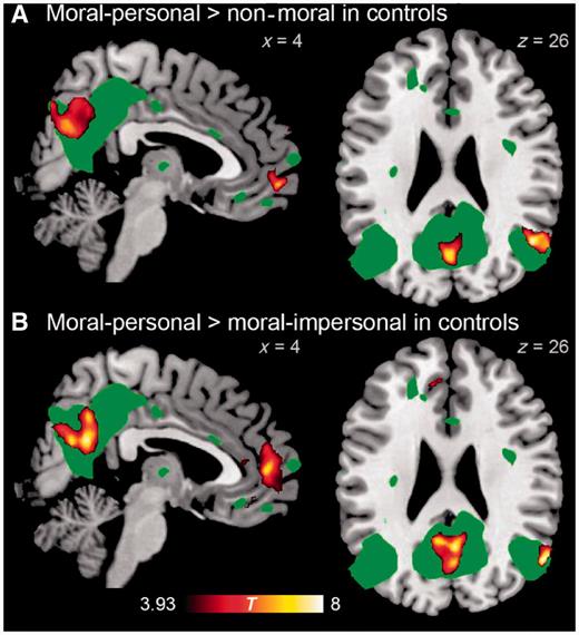 Brain regions demonstrating greater activity for moral–personal than for (A) non-moral dilemmas, and than for (B) moral–impersonal dilemmas in normal control subjects. For comparison, the default mode network as identified in resting state functional MRI from 15 control subjects is displayed in green at voxel-wise P = 0.0001.