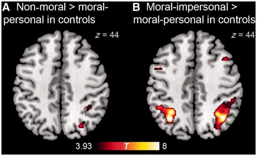 Brain regions demonstrating greater activity for (A) non-moral than for moral–personal dilemmas, and for (B) moral–impersonal than for moral–personal dilemmas in normal control subjects.