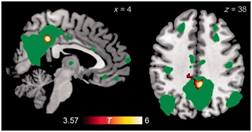 Brain regions demonstrating greater contrast between moral–personal and non-moral dilemmas in control subjects than in patients with behavioural variant FTD. For comparison, the default mode network as identified in resting-state functional MRI from 15 control subjects is displayed in green at voxel-wise P = 0.0001.