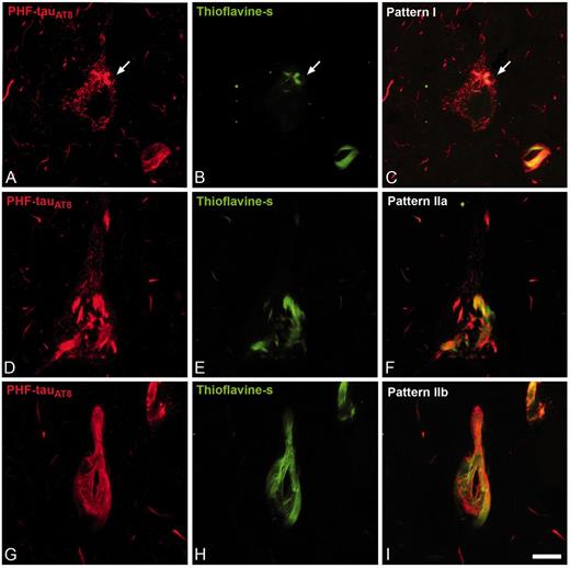Patterns of PHF-tau immunostaining. Confocal microscopy images showing neurons in parahippocampal cortex (A–C) and CA1 (D–I) double-stained with PHF-tauAT8 (red) and thioflavin S (green) (D–I) to illustrate Pattern I (neuron indicated with an arrow), Pattern IIa and Pattern IIb of immunostaining. Scale bars: A–I = 10 µm.